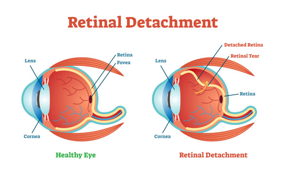 Retinal Detachment Graphic